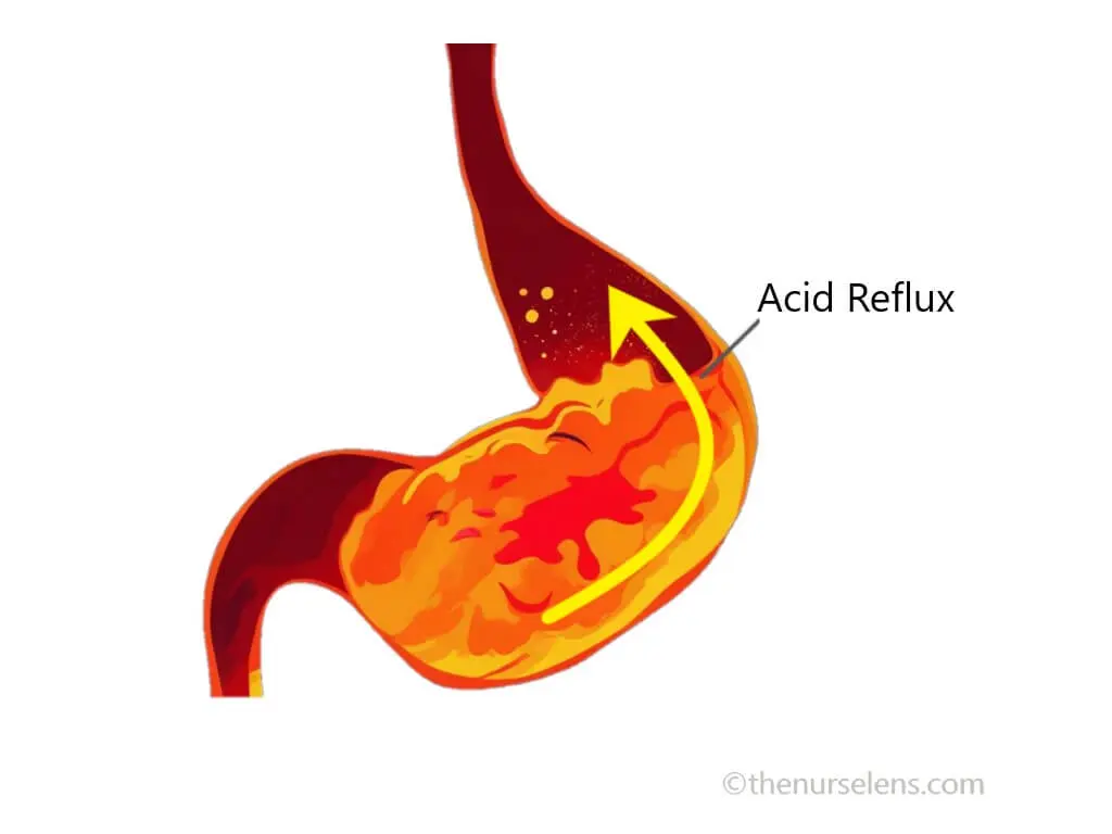 Comprehensive Guide to GERD: Causes, Symptoms, Diagnosis, Treatment, and Lifestyle Changes