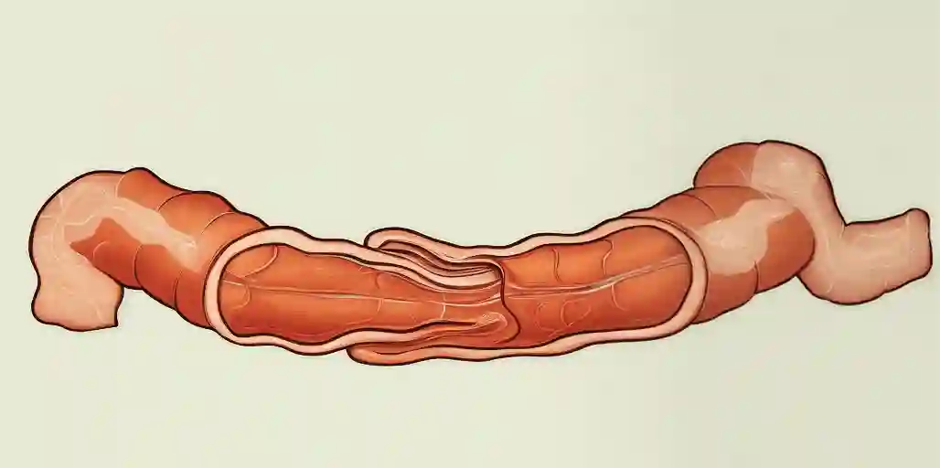 intussusception