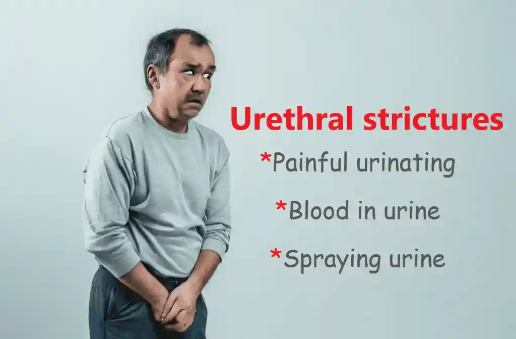 Urethral stricture