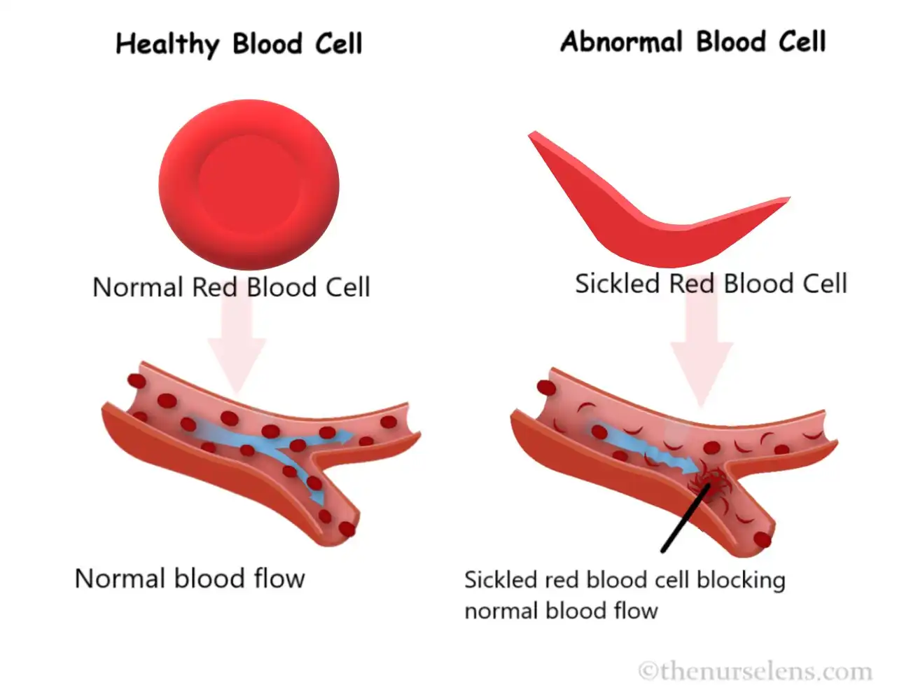 sickle cell