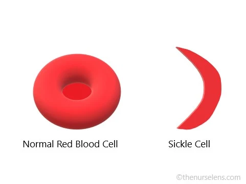 sickle cell