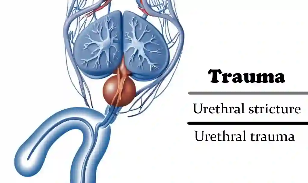 Urethral stricture