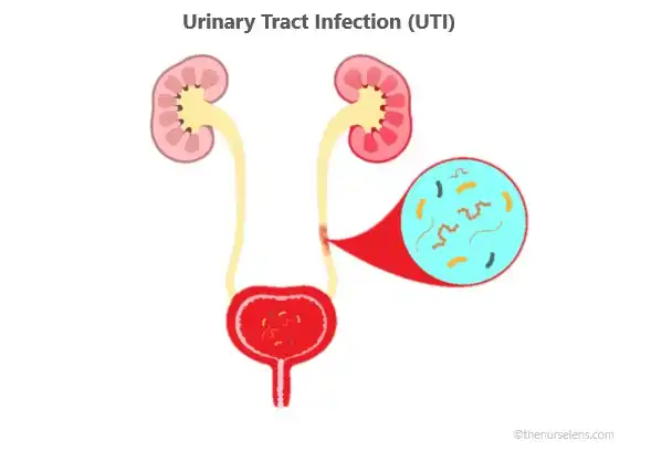 urinary tract infection ascending