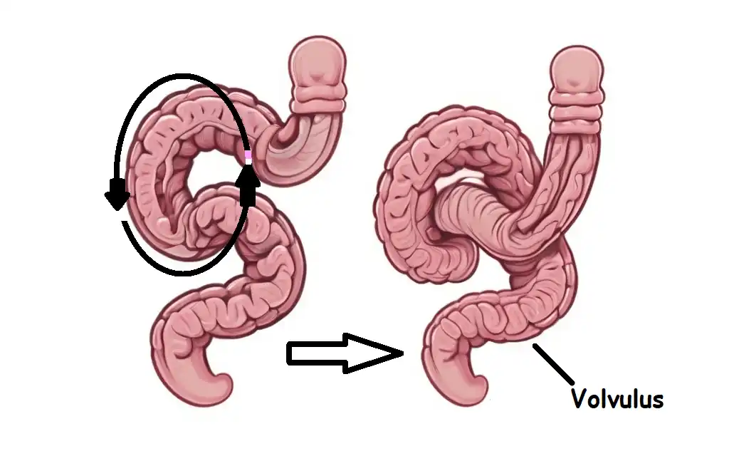 twisting of a bowel