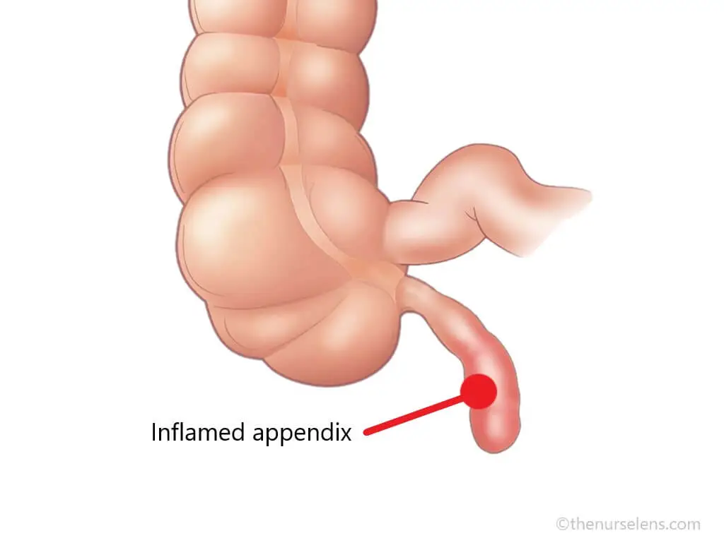 Inflamed Appendix: Appendicitis Inflamed Appendix