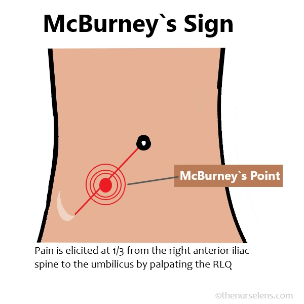 McBurney`s Point McBurney`s Point Appendicitis