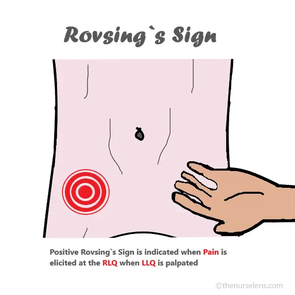 Positive Rovsing’s Sign Rovsing's sign appendicitis